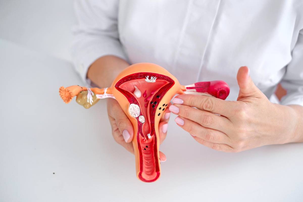 Modelo anatómico explicando qué es la endometriosis